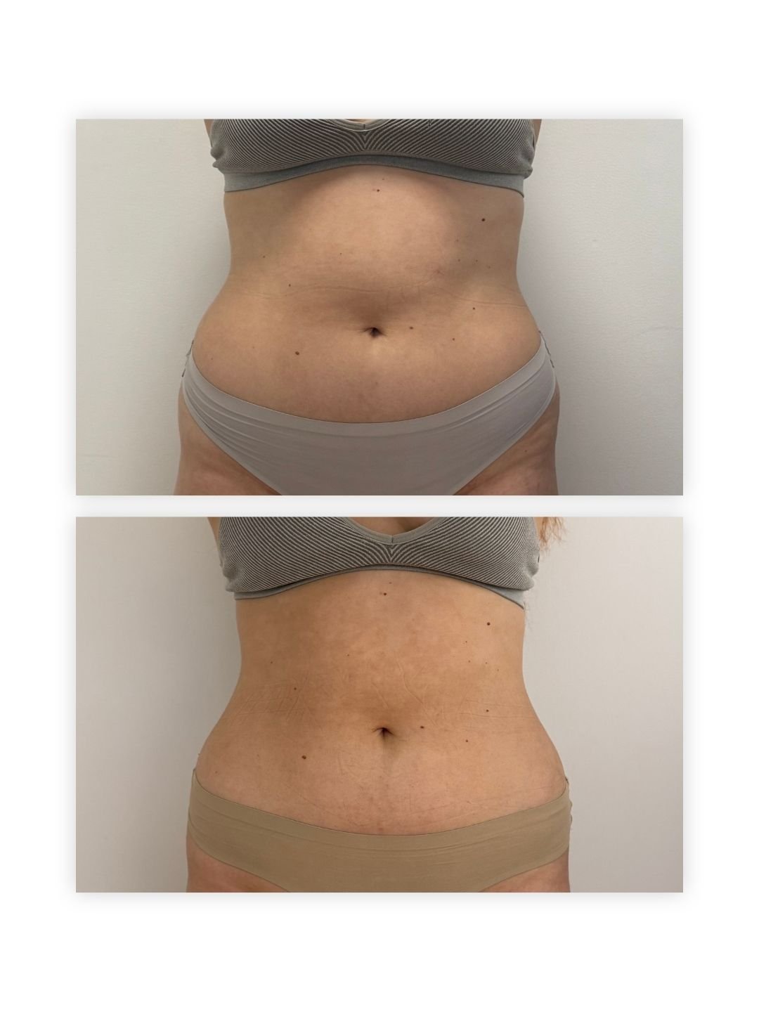 Front view of a client's abdomen and waistline before treatment on top and after treatment below