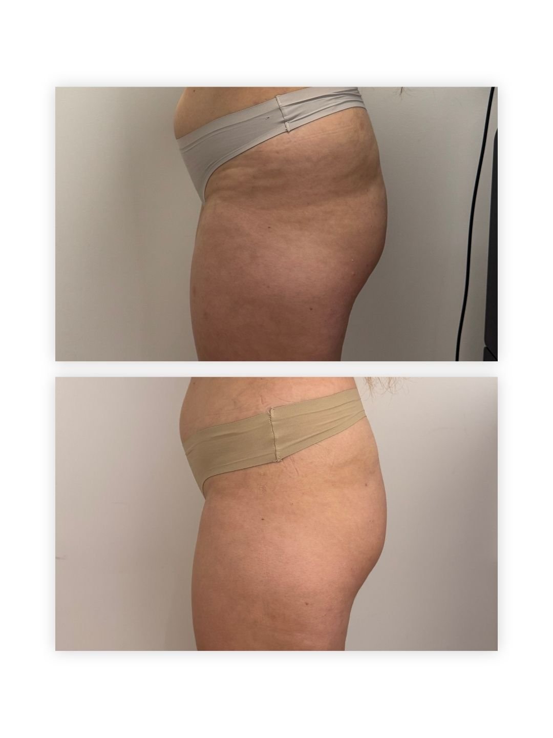 Side profile of a client's waist, hip and upper thigh before treatment on top and after treatment below