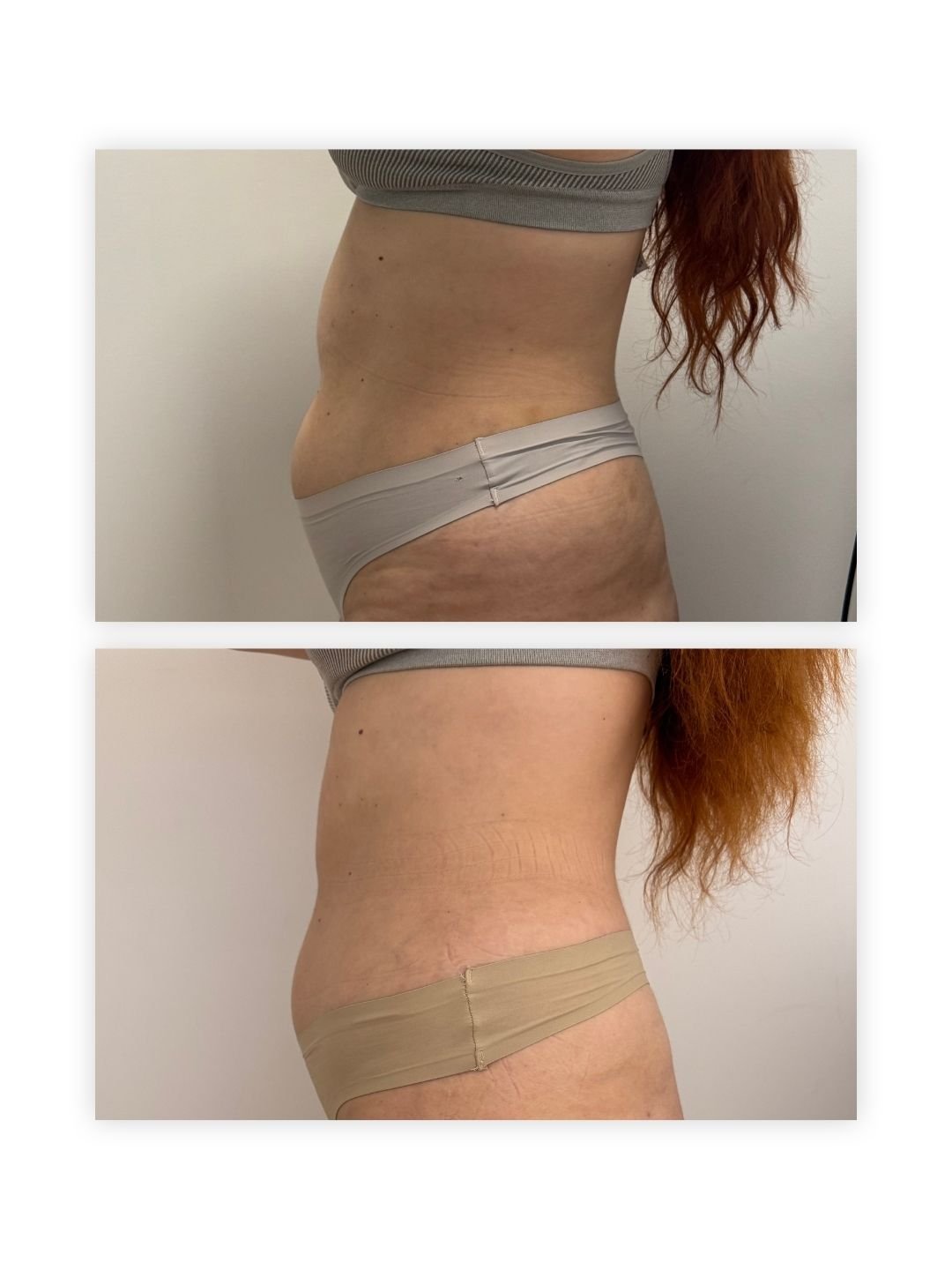 Three-quarter view of a client's waist, hip and upper thigh showing reduced cellulite appearance, before treatment on top and after treatment below